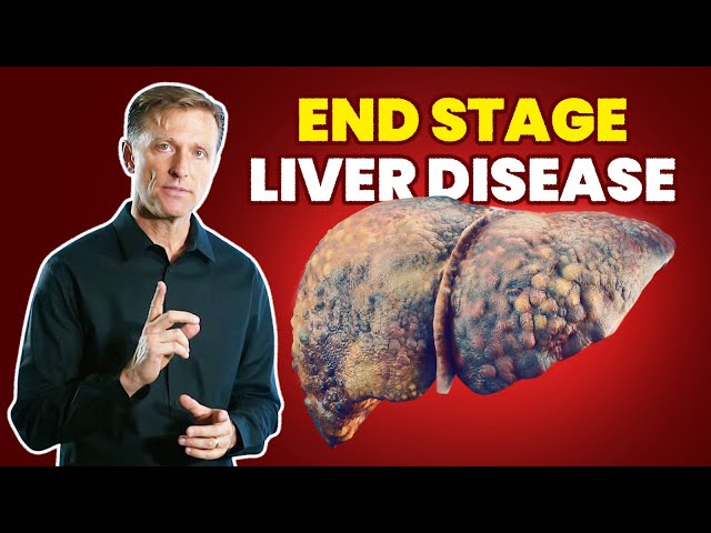 10 Signs Of A Dying Liver (End Stage Liver Disease) - Youtube