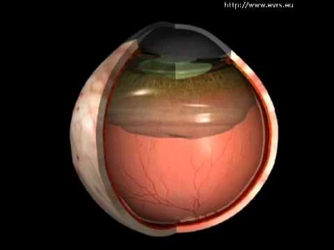 Video: Detasmen Vitreous Posterior: Sebab, Gejala Dan Banyak Lagi