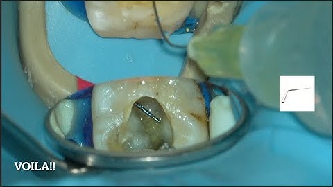 Separated file removal and ledge bypass