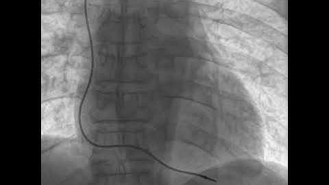 Pacemaker Implantation
