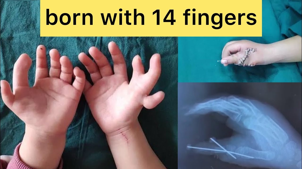 Girl born with 14 fingers undergoes lifechanging surgery to correct