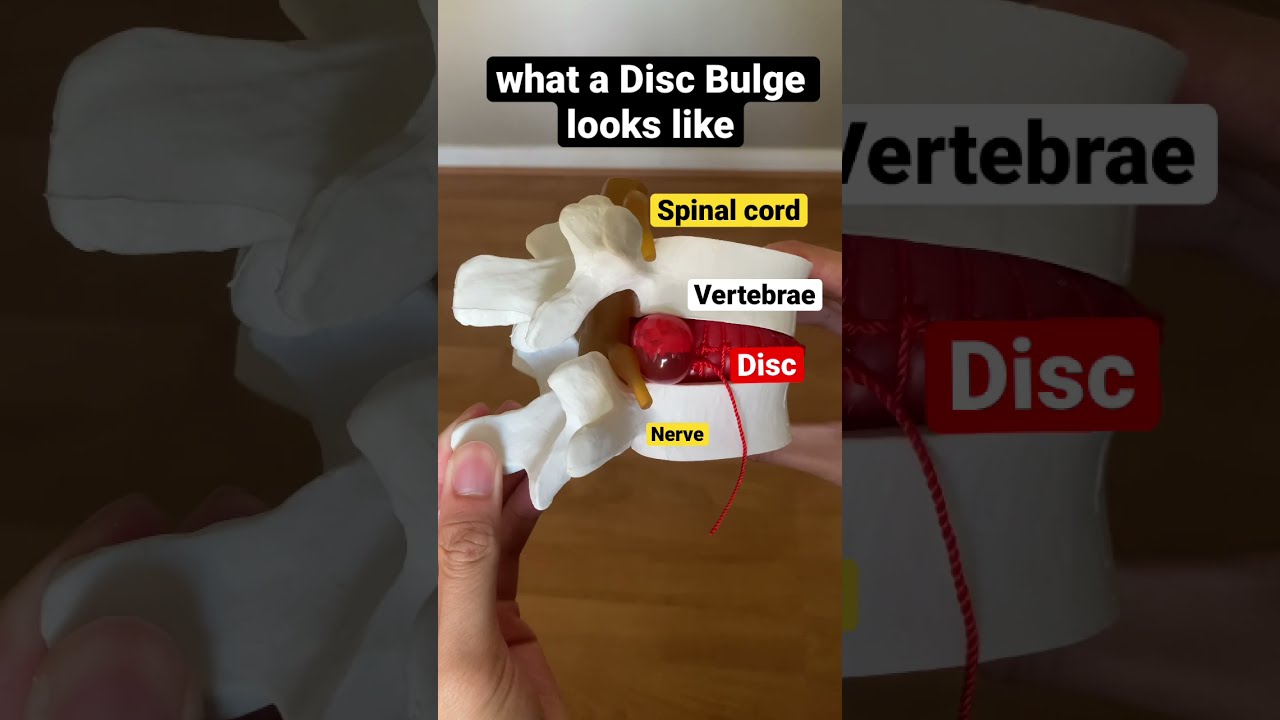 What A Disc Bulge Looks Like 