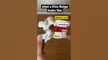 what a Disc Bulge looks like 😲