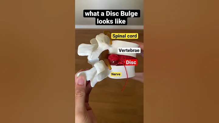 what a Disc Bulge looks like 😲