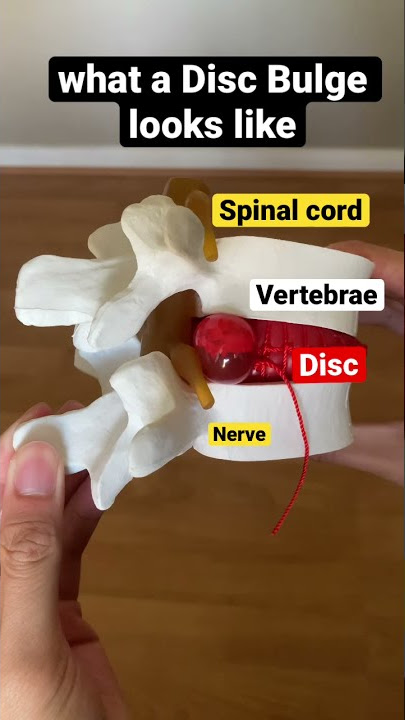 what a Disc Bulge looks like 😲