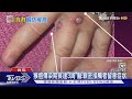 傷口沾確診者水泡液 日常接觸染疫風險低|TVBS新聞