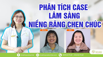 Niềng răng chen chúc - Phân tích chi tiết case lâm sàng