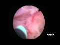 Adiva hospitals on treatment of prostatic gland using laser holmium laser