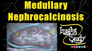 Medullary Nephrocalcinosis Ultrasound Case 128