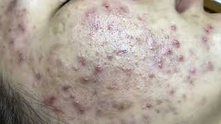 Blackhead Removal: Satisfying Routine - blackheads lips , Nose - ingrown hair removal   2025