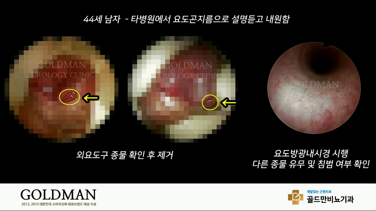 골드만 비뇨의학과 비뇨질환 - 요도암