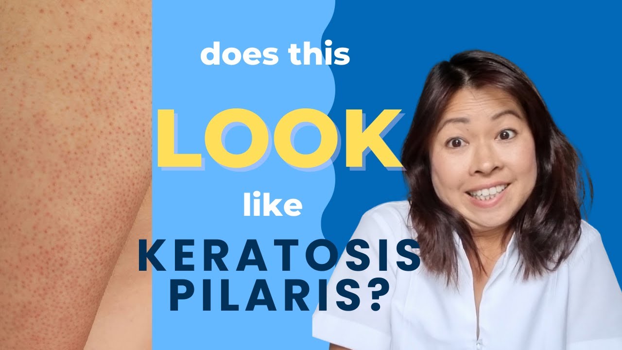 Does this look like keratosis pilaris (KP)? YouTube