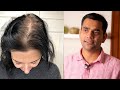 Причины выпадения волос у женщин | Доктор Вивек