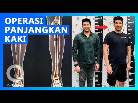 Lakukan Operasi Pemanjangan Kaki, Pria ini Tambah Tinggi Secara Permanen - TomoNews