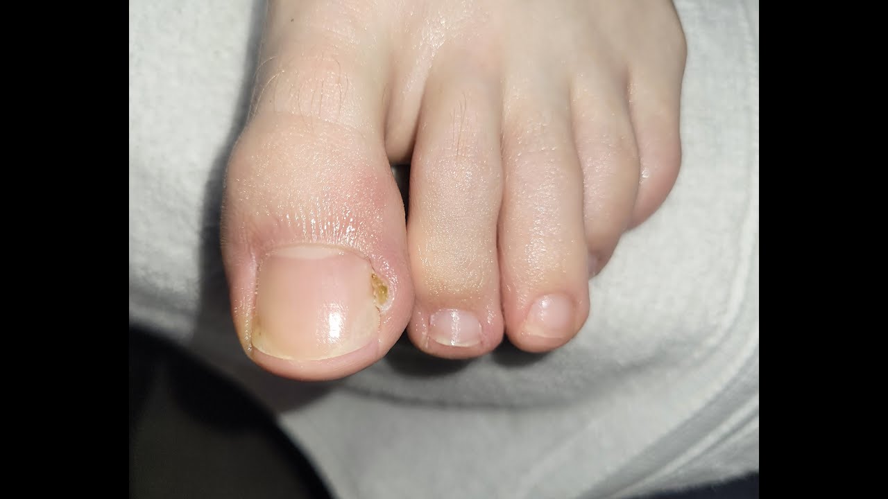 What is causing his TOENAIL PAIN AND INFECTION? YouTube