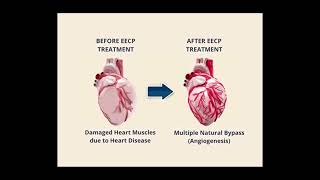 Eecp Information In Konkani. Treatment For Heart Blockages. Dr Milind Desai Md Margao Goa