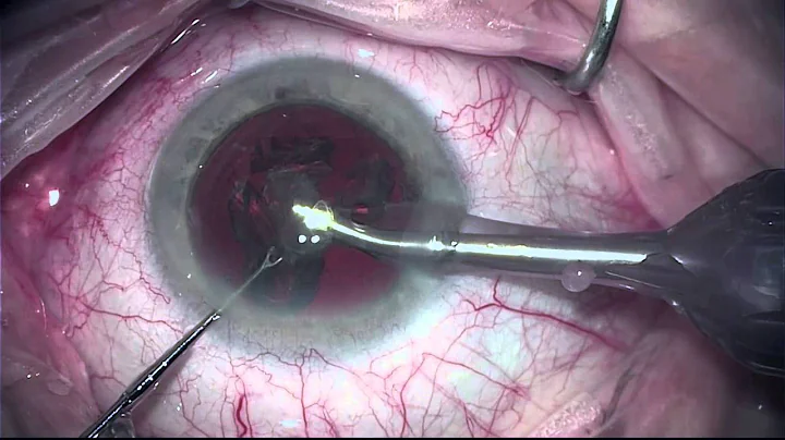 Anthony Lombardo, M.D - Routine Cataract