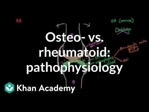 Osteoarthritis vs rheumatoid
