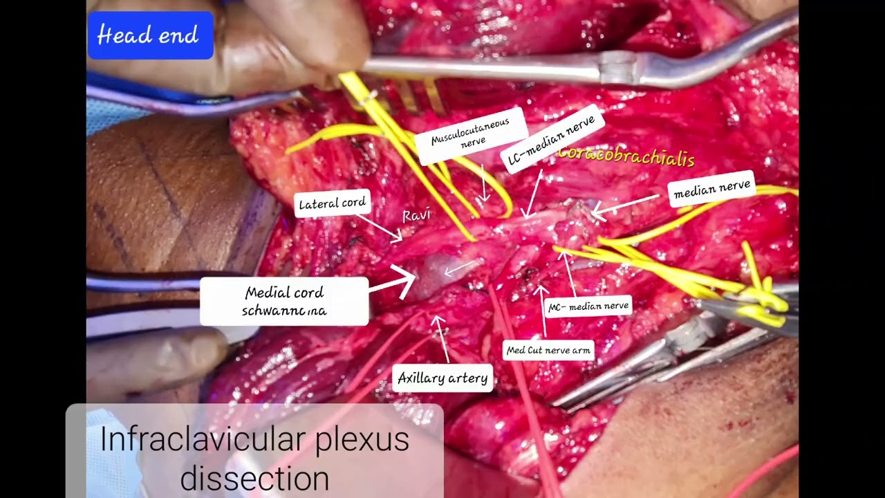 Brachial plexus schwannoma- Enucleation