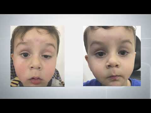 د قسيم جميل ناصر ترهلات محجر العين