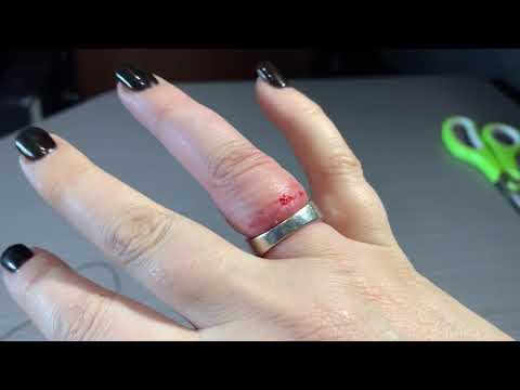 Как разрезать кольцо на пальце в домашних условиях