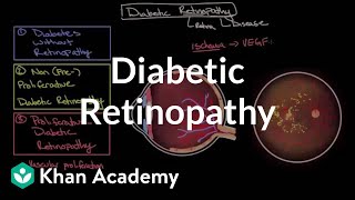 Diabetic retinopathy | Endocrine system diseases | NCLEX-RN | Khan Academy screenshot 3
