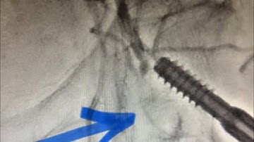 CTO- Chronic total occlusion of the CFA Common Femoral Artery. High-Risk Lithotripsy & Angioplasty!