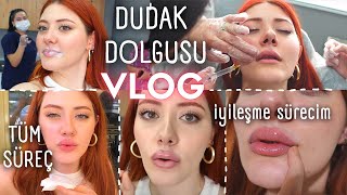 Dudak Dolgusu YaptırdımVLOG Tüm süreç, iyileşmem, dolgu hakkında bilgilendirme HER ŞEY BU VLOGDA