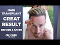 GREAT RESULT | Hair Transplant | Dr. Emrah Cinik