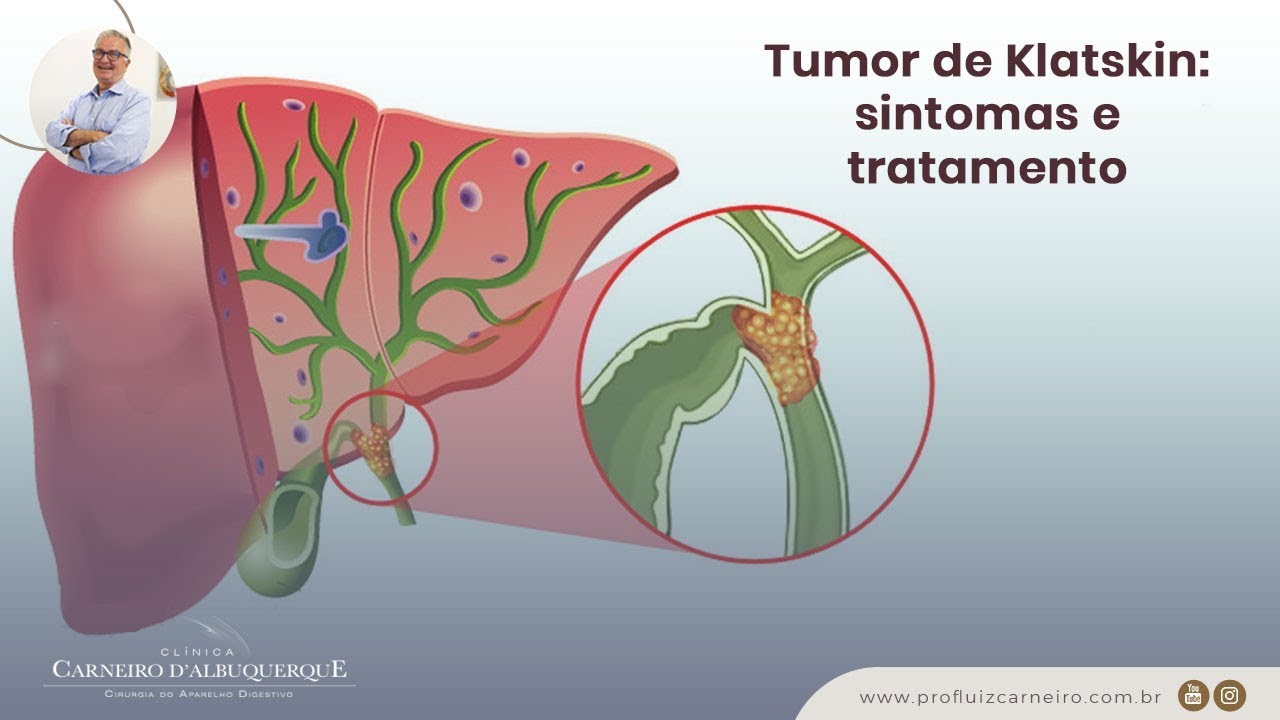 Que es cancer biliar - Cancer biliar tratamiento