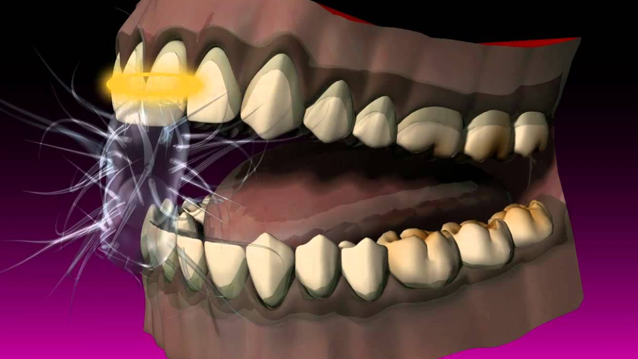 Atherosclerosis - Plaque Animation Model