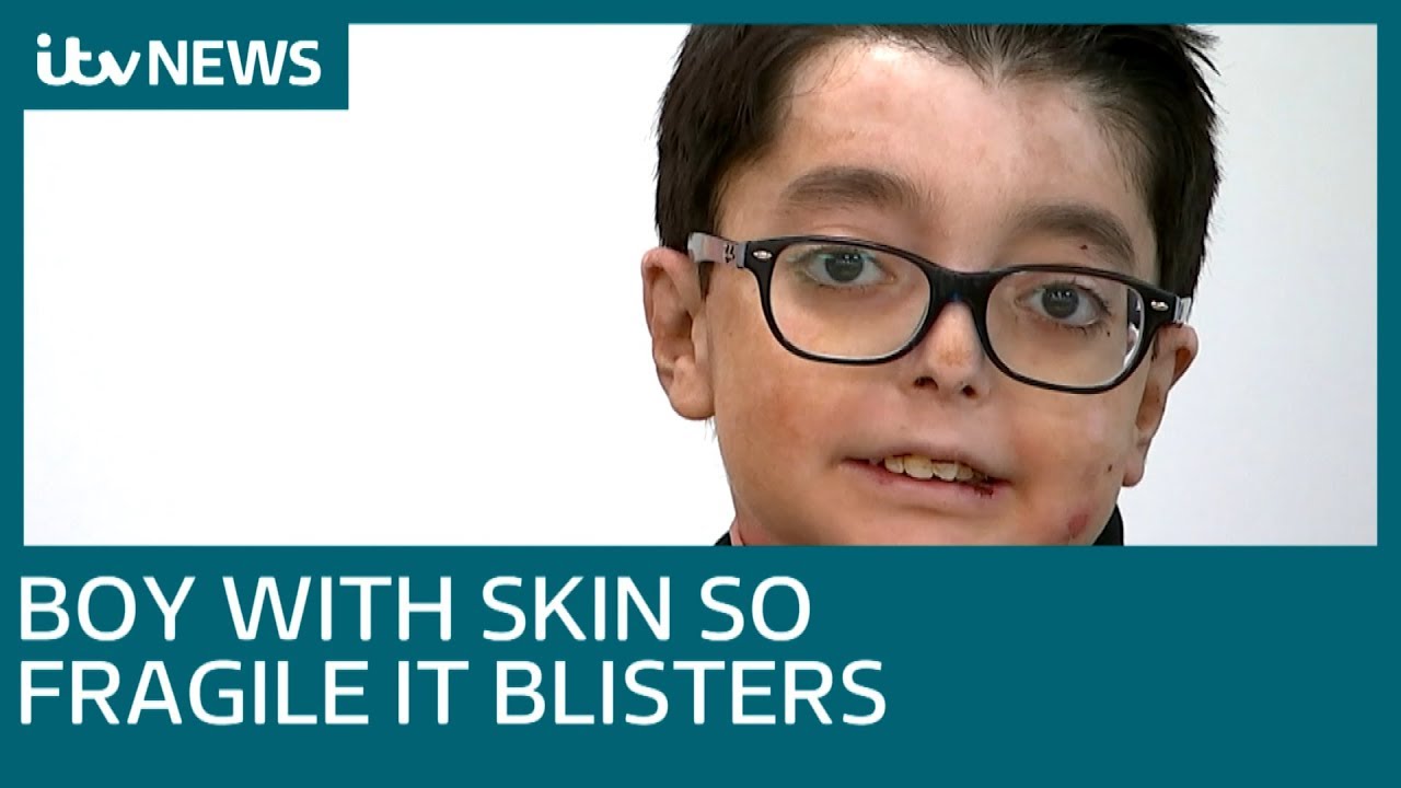 newspaper mockup Boy with fragile skin spends spare time motivating others | ITV News