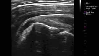 MSK Ultrasound Rotator Cuff Stress Test