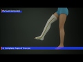 Hm cast long leg 3d procedure