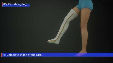 HM CAST Long Leg (3D Procedure)