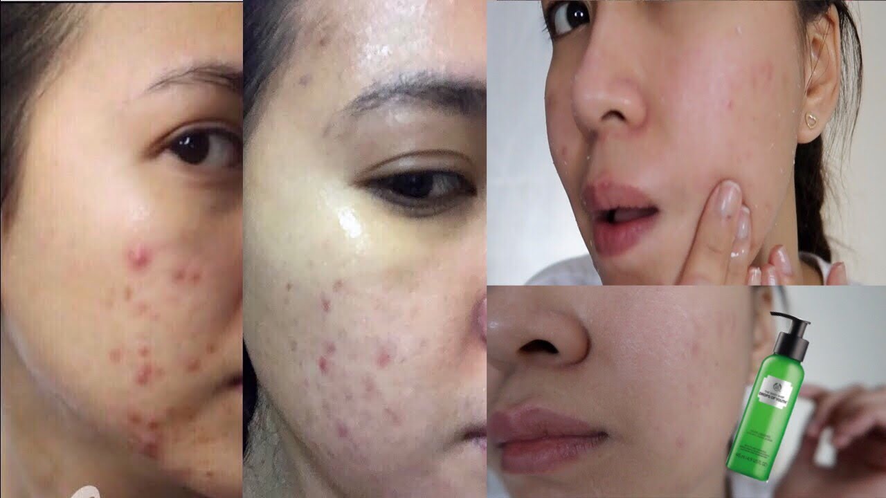 The Body Shop Drops of Youth Liquid Peel Review + Demo on Acne Prone