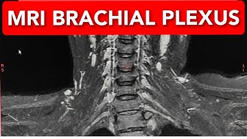 MRI Brachial Plexus on GE 1.5 Tesla.