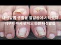 [시원함주의!!]😨발톱이 아파서 깎을 수 없었던 내성발톱😱끝나고 가실 때 환호하심!!👍(ingrown toenail/toenails with fungus)