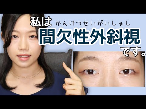 私は「間欠性外斜視」です/斜視って何？/実際の見え方/見た目の問題/今後について【おしゃべりおじこ番外編】