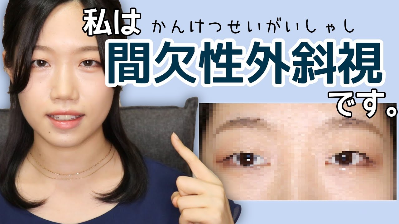 私は 間欠性外斜視 です 斜視って何 実際の見え方 見た目の問題 今後について おしゃべりおじこ番外編 Youtube