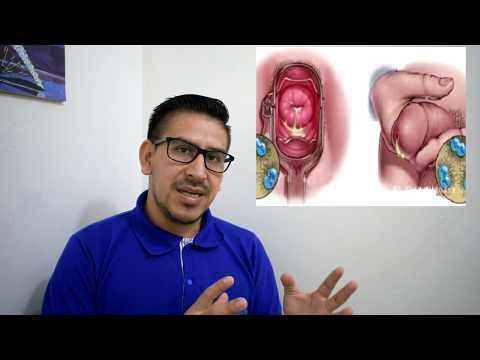 Vídeo: Diferencia Entre La Candidiasis Y La Gonorrea