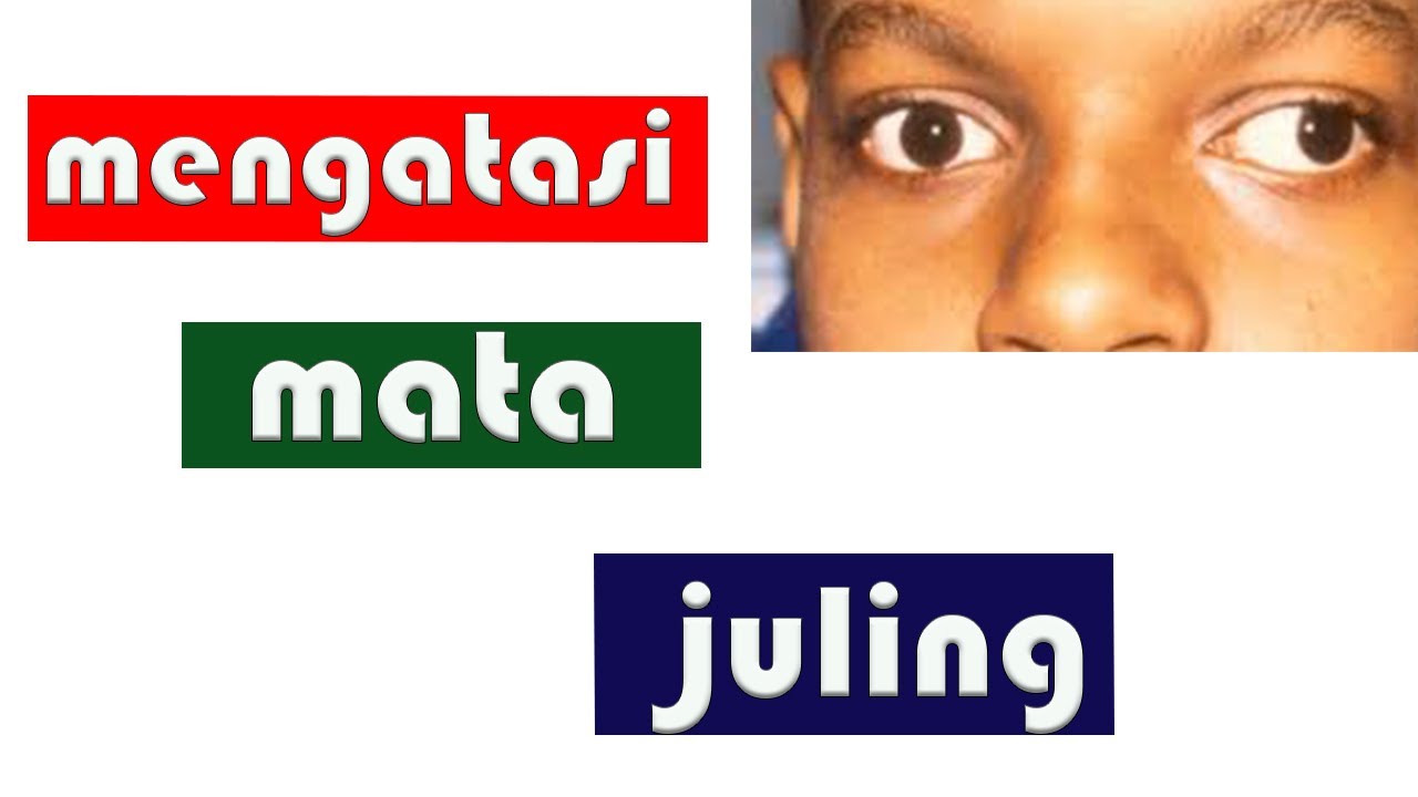 CARA MENGATASI MATA JULING