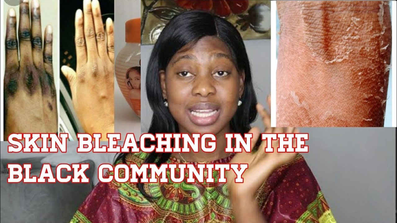 IS THIS WHY BLACK WOMEN BLEACH THEIR SKIN? SKIN BLEACHING YouTube