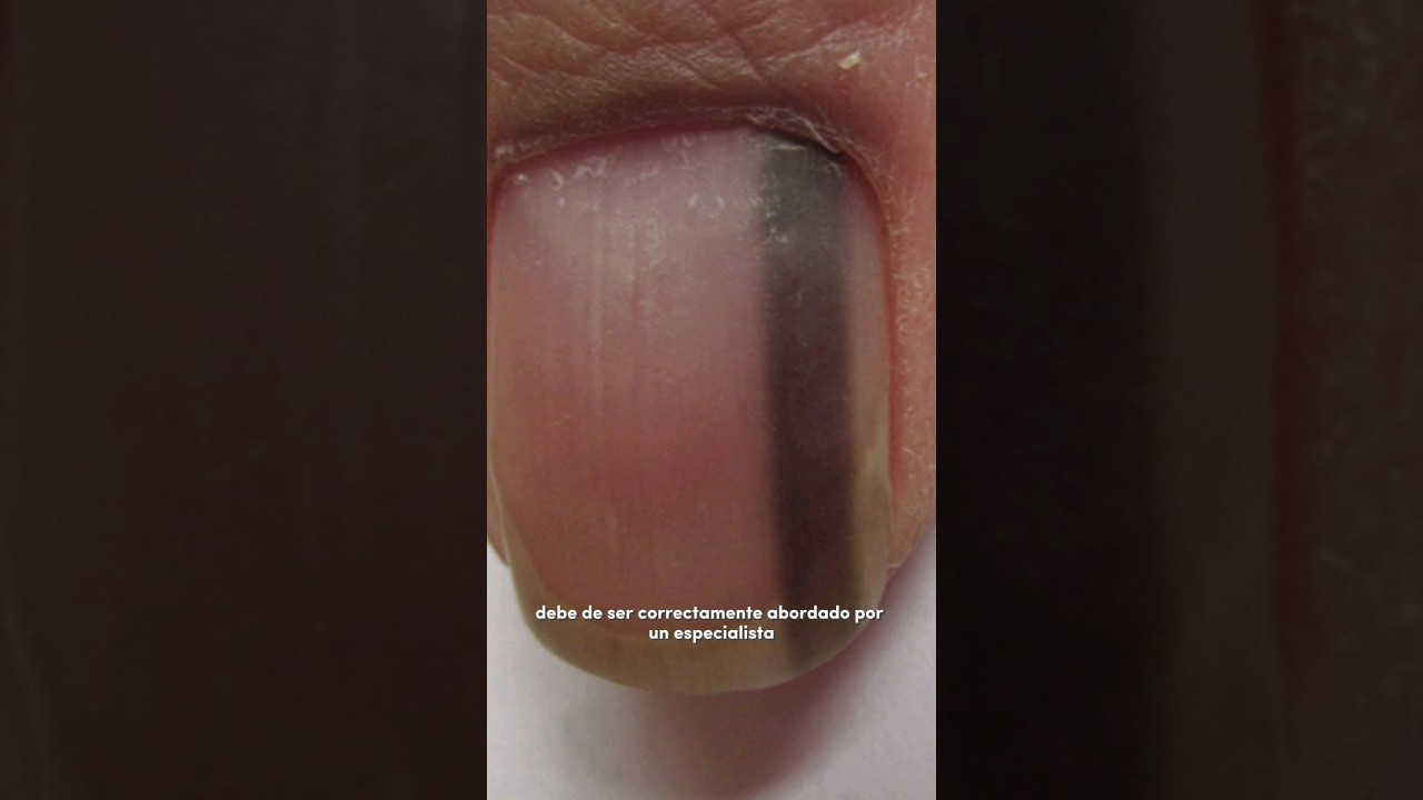 Línea o banda oscura en la uña 