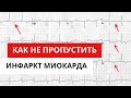 Как не пропустить инфаркт миокарда. Сложности анализа ЭКГ.