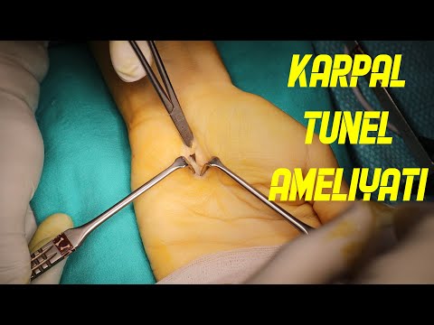 KARPAL TÜNEL AMELİYATI || OP. DR. UTKU ERDEM ÖZER