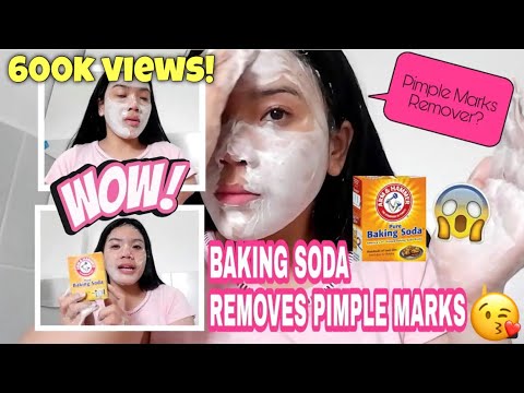 BEST PIMPLE MARKS REMOVER | USING BAKING SODA |  VLOG #7