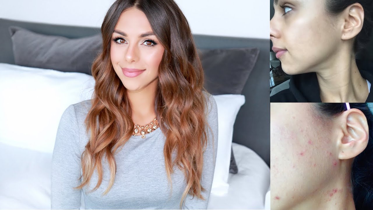 Skin & Diet Update | Mistakes I Made | Annie Jaffrey