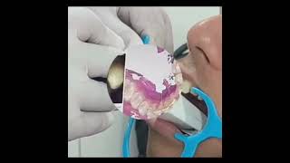 Information Intraoral Scanning! with latest 3D Tools and Techniques | Topazdent Dental Update