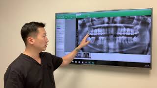 Why should you get your wisdom teeth removed?
